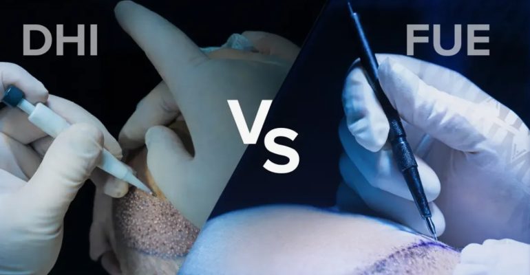 FUE or DHI: How Modern Hair Transplant Methods Differ